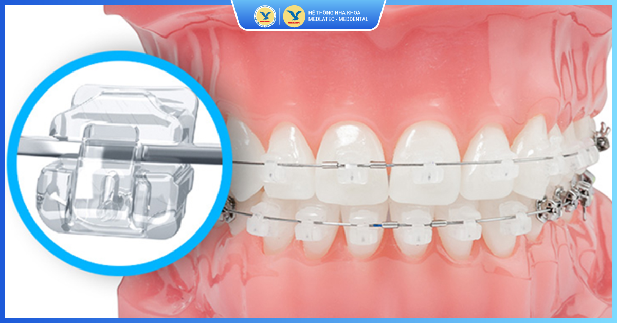Niềng răng mắc cài sứ có đau không? - Niềng răng mắc cài sứ