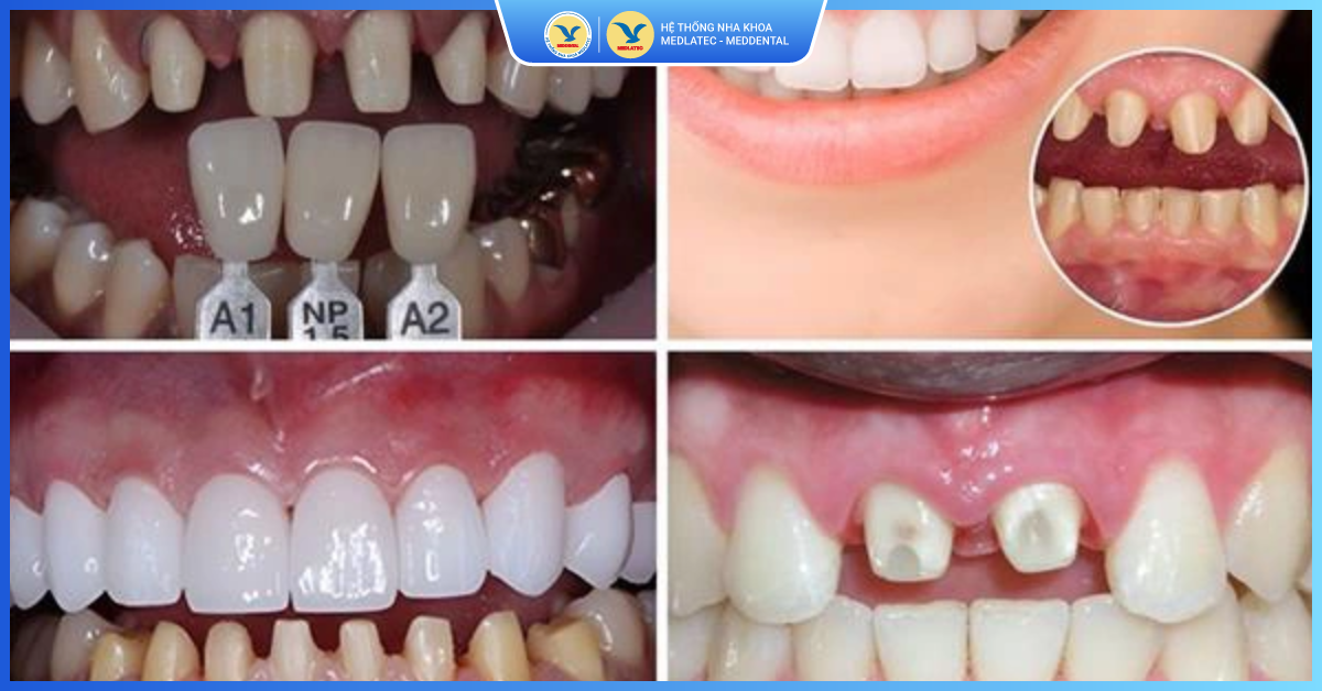Bọc răng sứ có những ưu điểm gì nổi trội? - Bọc răng sứ thẩm mỹ