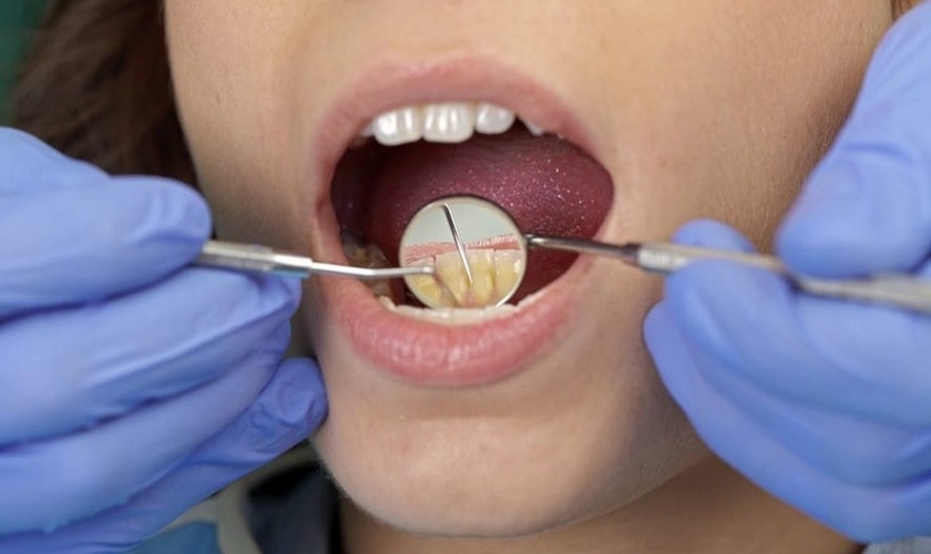 Cạo vôi răng định kỳ tại nha khoa để khắc phục hôi miệng