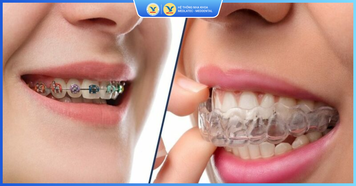 Niềng răng Invisalign có gây tình trạng đau nhức không? - Niềng răng trong suốt Invisalign